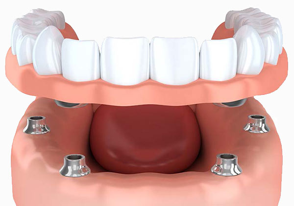retained dentures